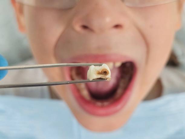 Best Emergency Tooth Extraction in Star, NC